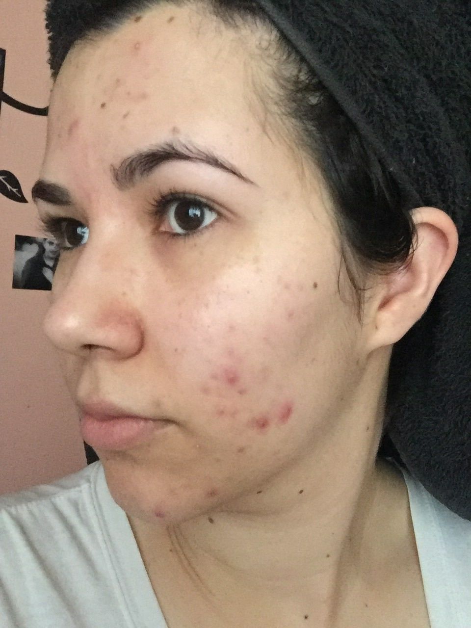 Acne before treatments