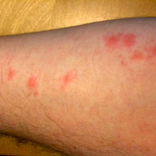 BED BUGS: Bite marks on subject's arm.