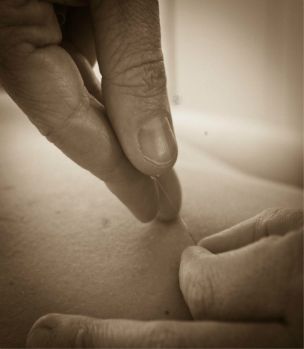 Gentle acupuncture, using sterile, hair-thin needl