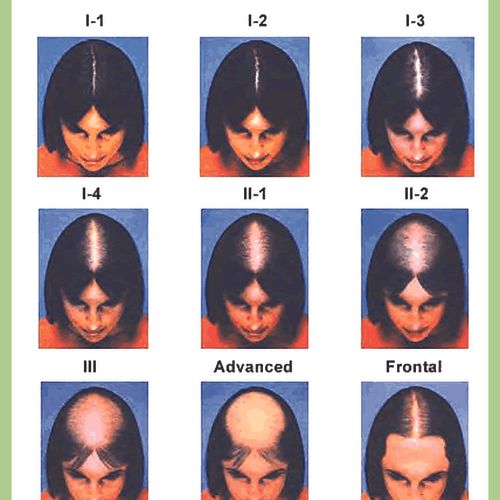 Front of a rack card for a hair loss salon in Brad