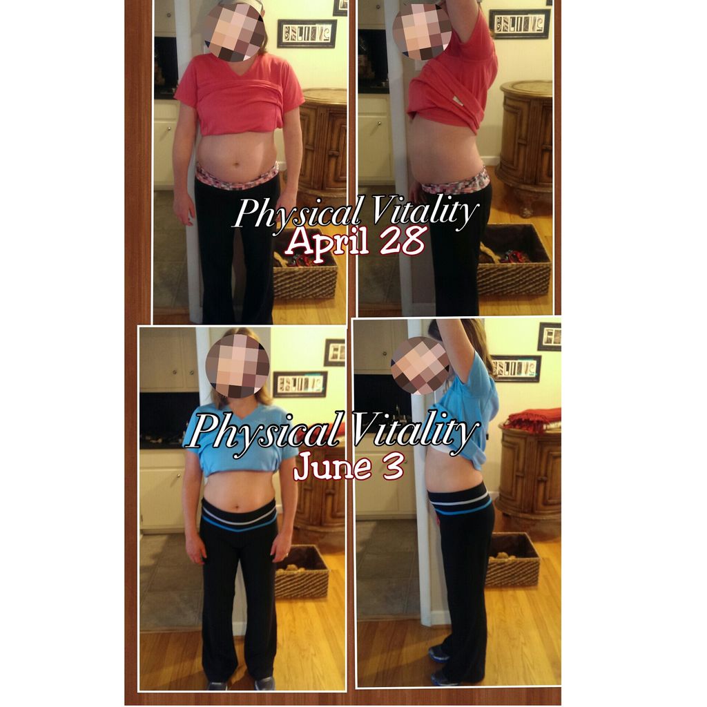 Diastasis recti is a separation between the left a