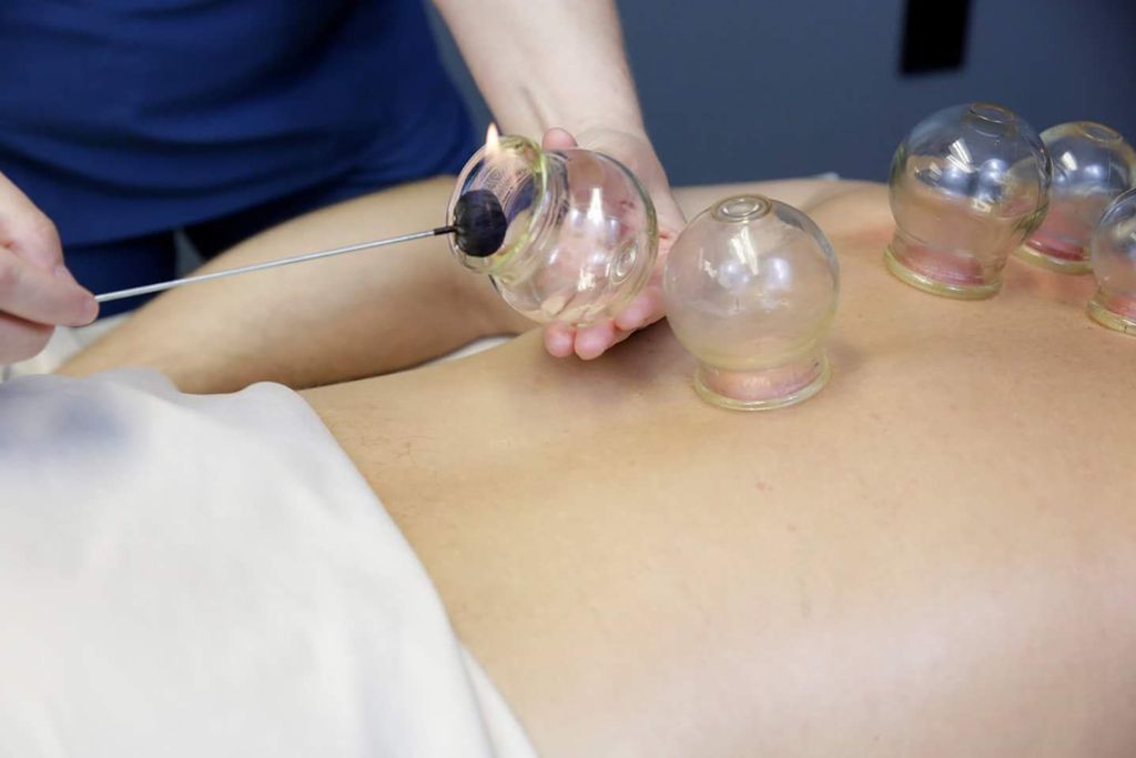 Fire Cupping