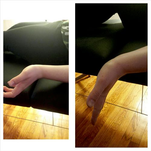 Most recent elbow/forearm case study: Patient was 