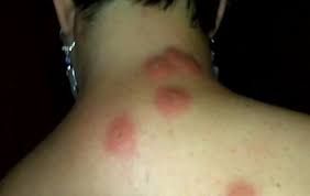 Bed Bug bite reactions