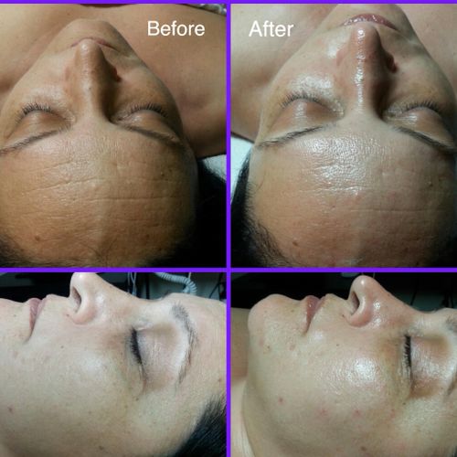 Microdermabrasion with hydration facial