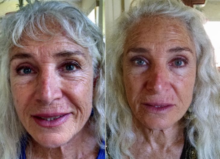 Before and After