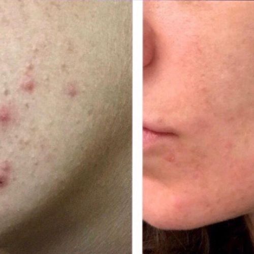 Before and After Acne Facials