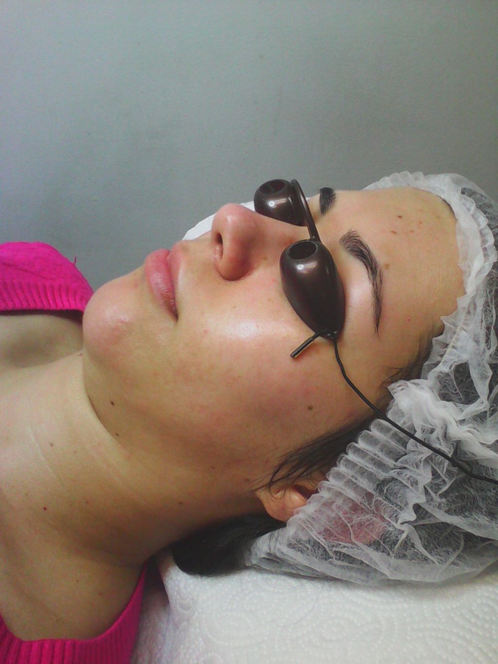 After Acne & Microneedling