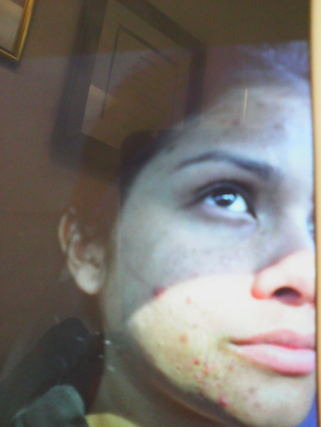Acne before