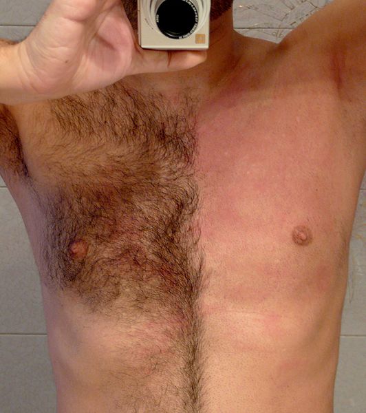 Hair Removal (before and after) for men or women