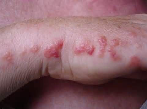 Bed Bug Bites