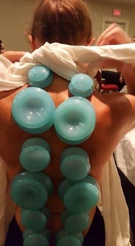 Cupping therapy using Baguanfa Cups. 