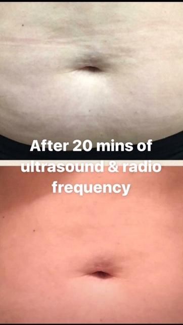 Body Contouring offered! Ask about package deals!