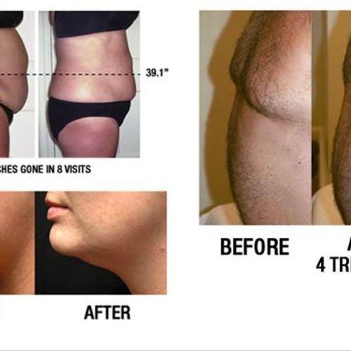 Laser-like lipo for targeted inch loss