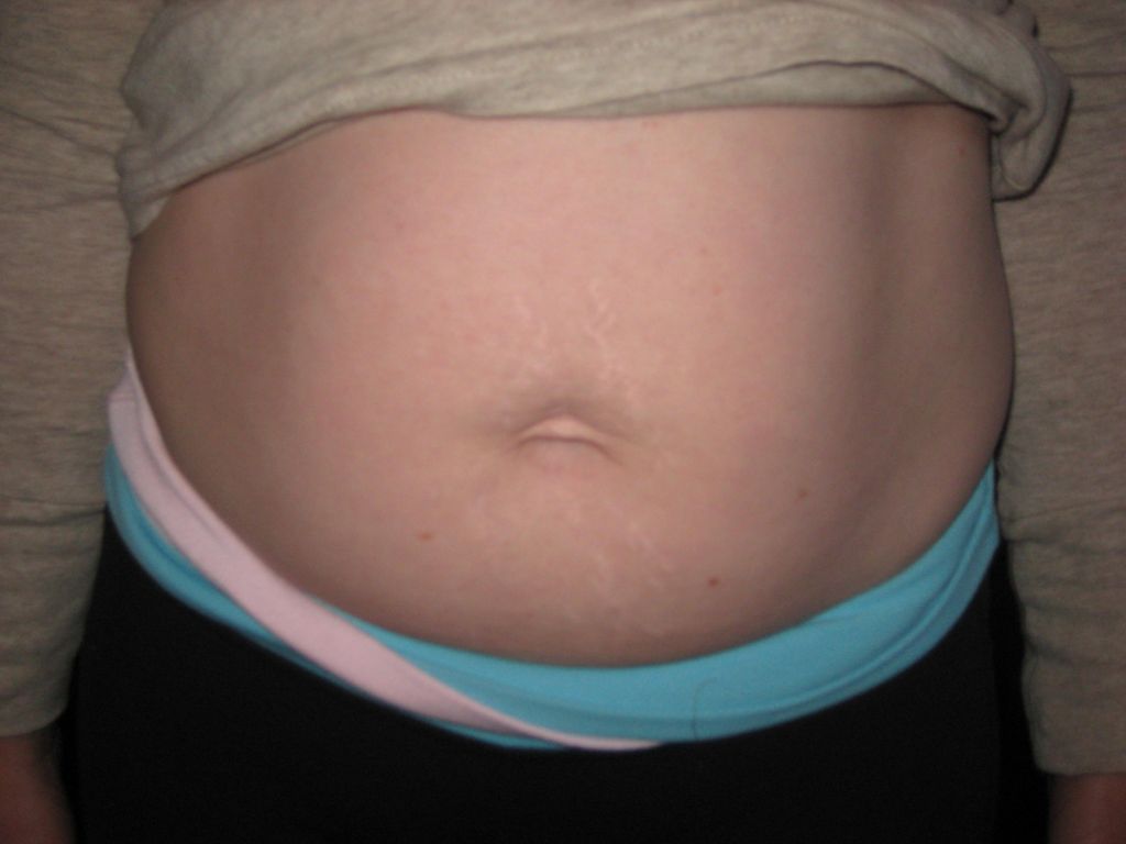 BEFORE diastasis recti rehab