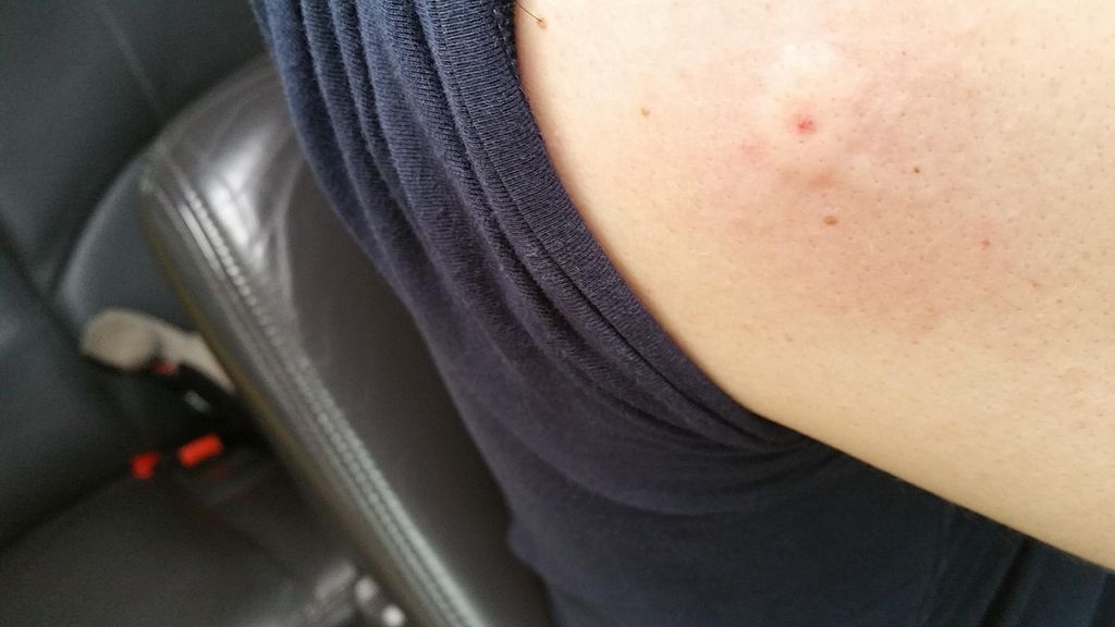 I got stung by a Bald Face hornet...Man does that 