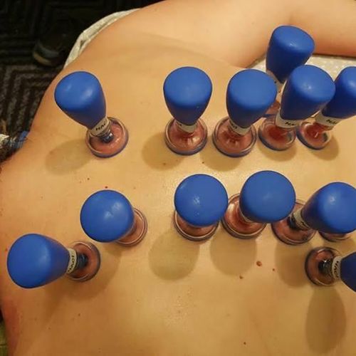 Cupping therapy using Baguanfa Cups & Haci Cups.