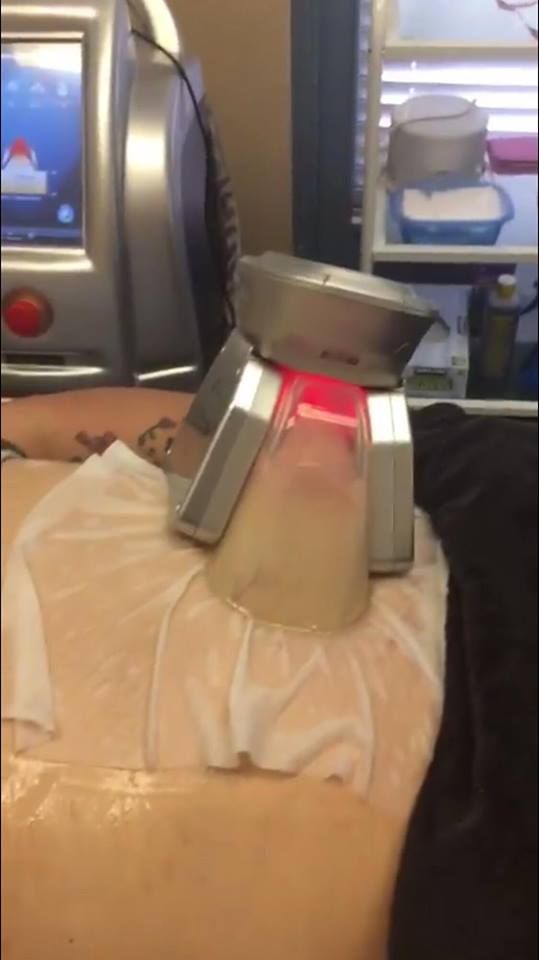 Current Special on Cyro Freeze Fat Reduction!!