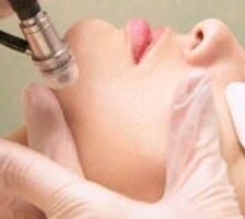 Microdermabrasion Treatment. 
