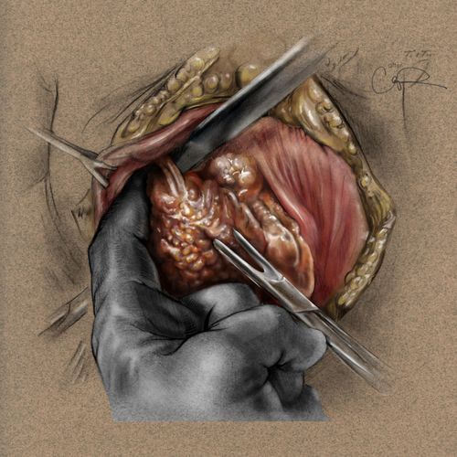 Surgical illustration of thyroidectomy. 

Graphite