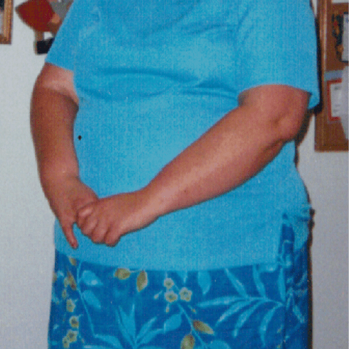 A photo of me before Gastric Bypass and hypnosis.