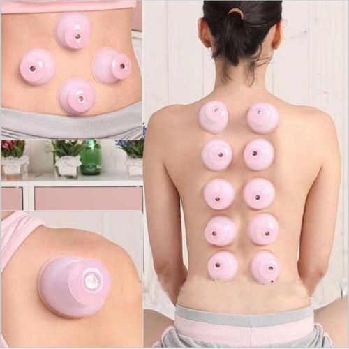 cupping Therapy star $40