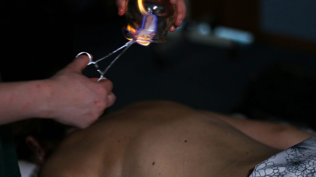 Chinese Fire Cupping!