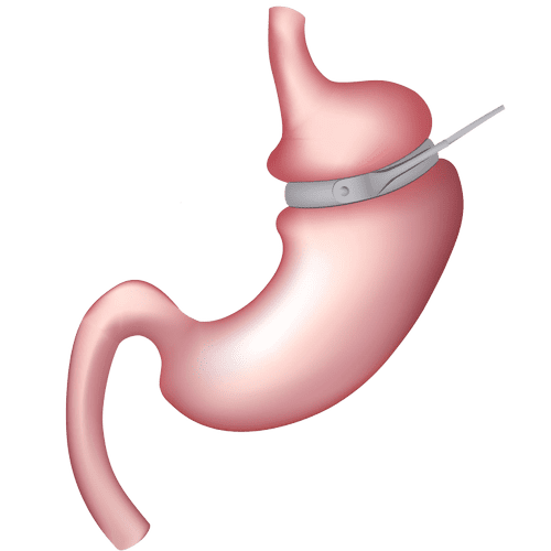 Call us for more info on the Virtual Gastric Band 