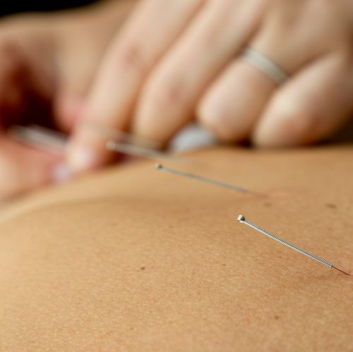 Acupuncture for Pain relief
