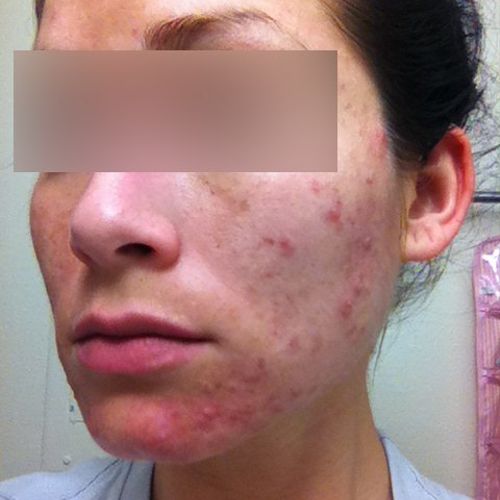 Client with Acne Before Treatments