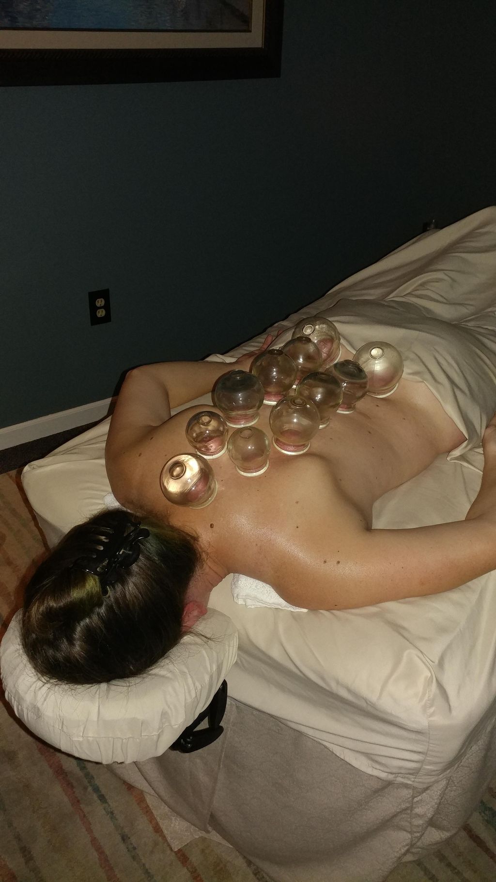 Fire Cupping