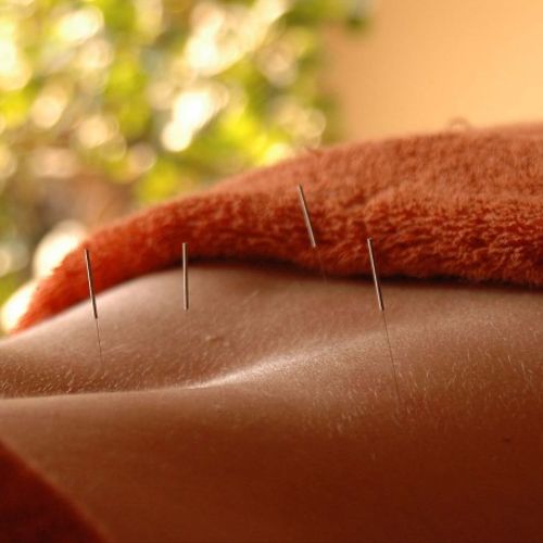 Painless acupuncture techniques!