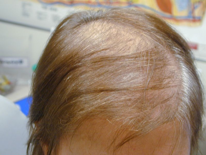 Before: The Lotus Concept's 
"Advanced Hair Loss S