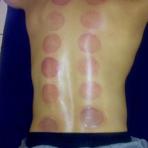 An example of cupping massage results on a former 