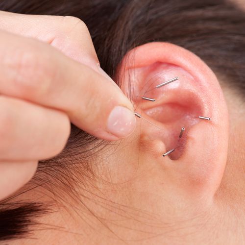Auricular Acupuncture: used for a variety of healt