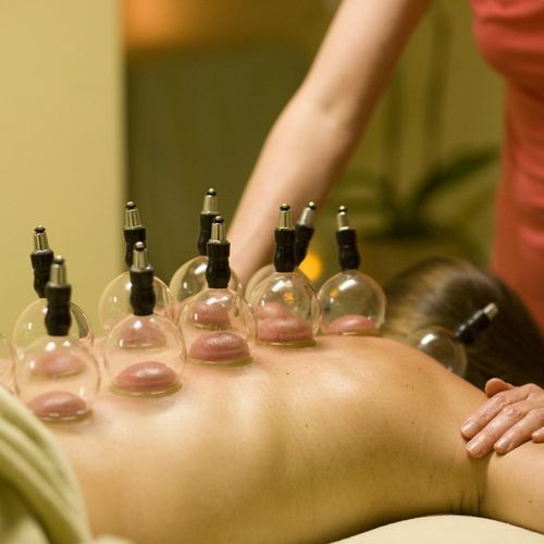 cupping?Chinese medicine in which it is the proces