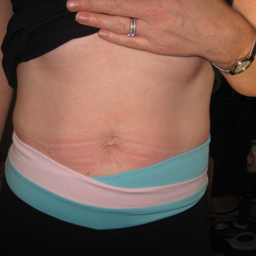 AFTER 8 week of diastasis recti rehab with Abby