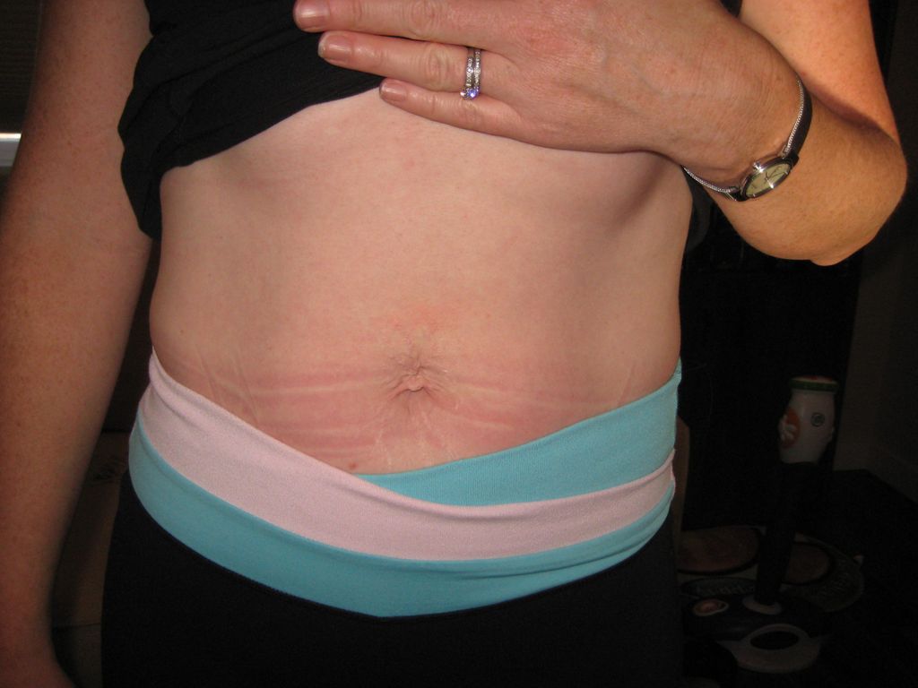 AFTER 8 week of diastasis recti rehab with Abby