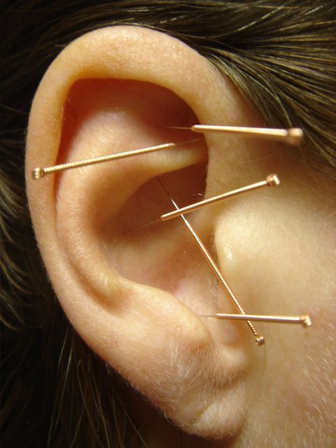 Acupuncture Detoxification Protocol