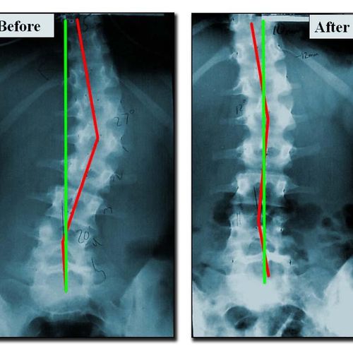 before and after scoliosis treatment