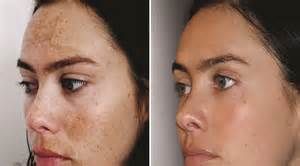 Chemical acid peels for skin rejuvenation and for 
