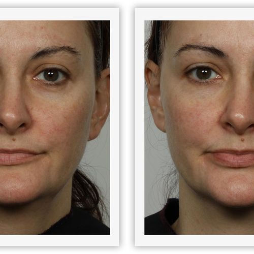 Facial Toning Before & After