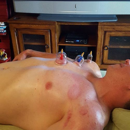 Cupping is effective to increase blood and lymph c