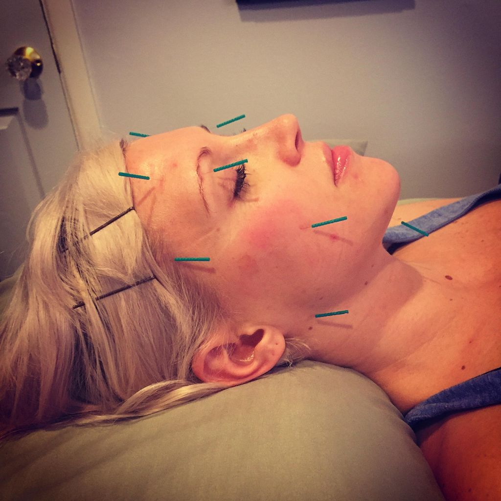 Facial Rejuvenation Acupuncture