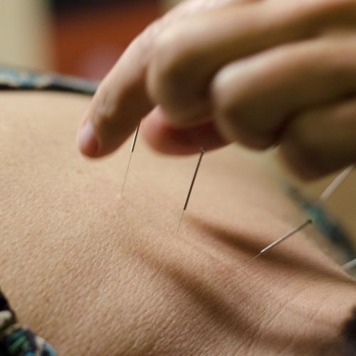 Acupuncture services provided in Mesa, AZ.