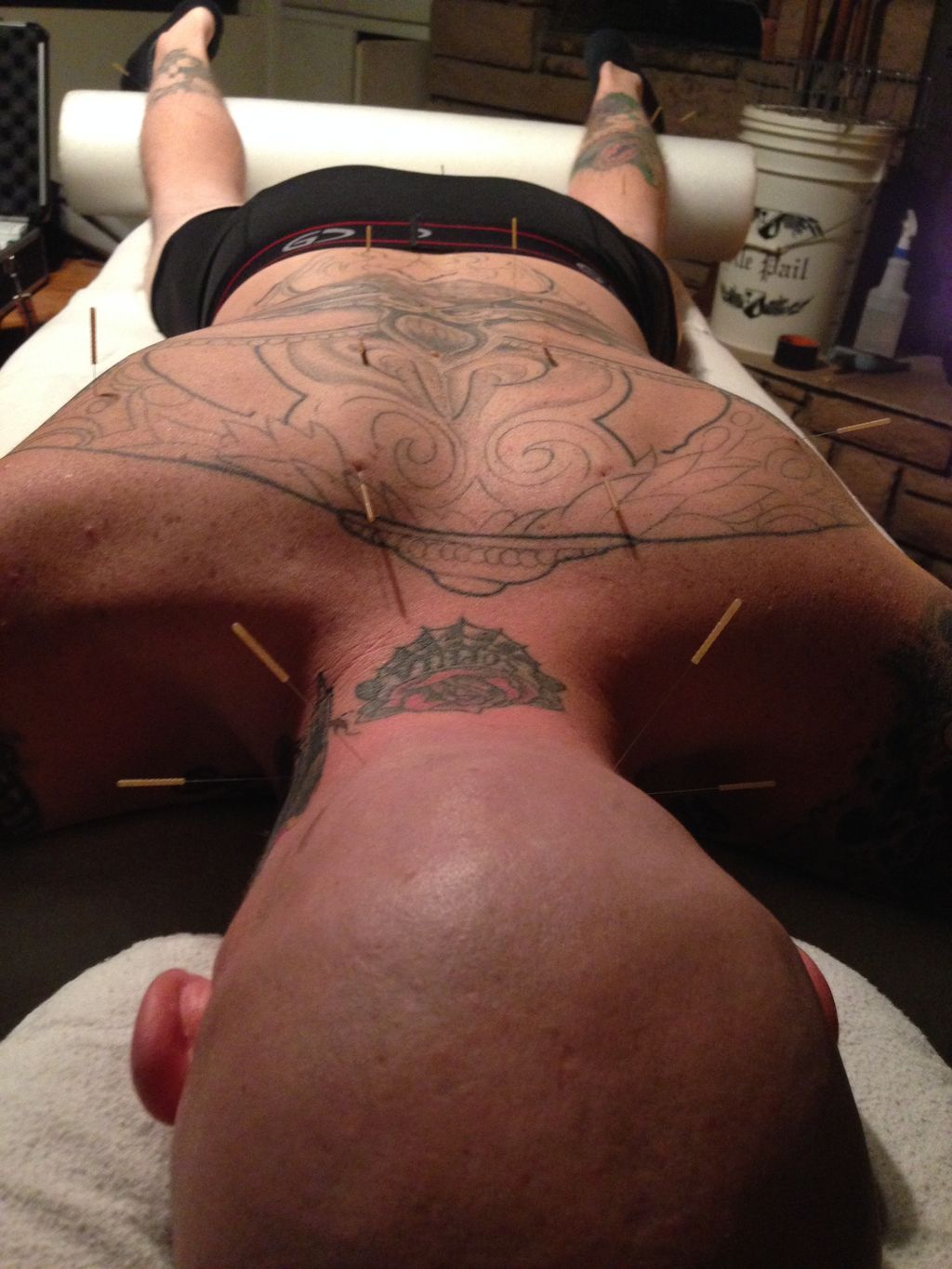 Sports Medicine Acupunture
