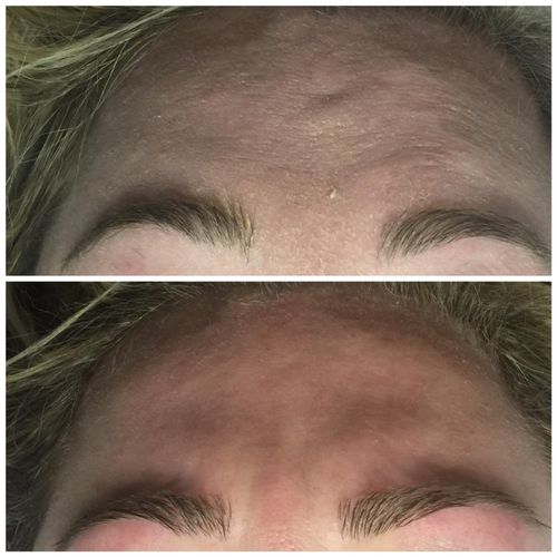 Hydrating facial before and after