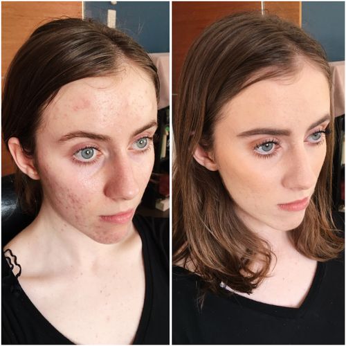 Acne coverage before and after