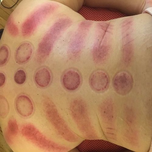 I went in for the therapeutic cupping treatment be