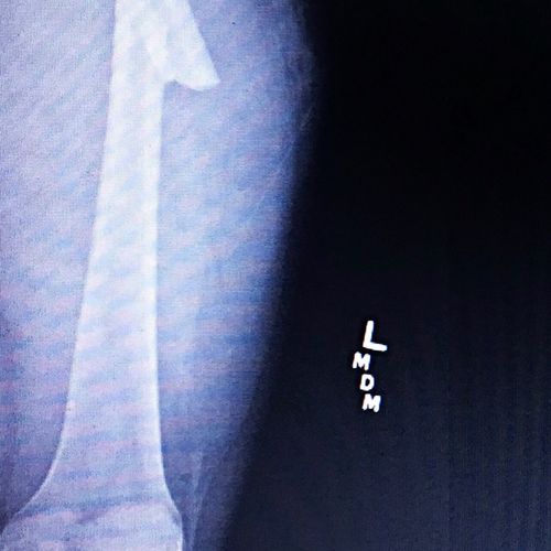 Broken femur bone.  Mr Weinstein got me doctor to 